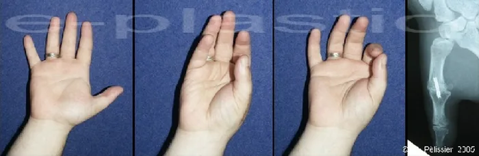 Arthroplastie — figure 2