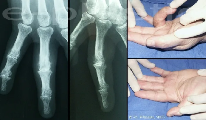 Arthroplastie — figure 3