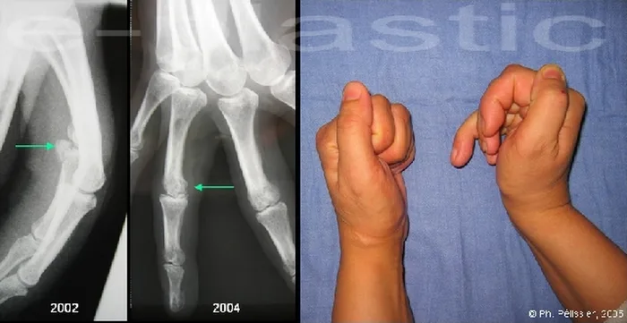 Arthroplastie — figure 4