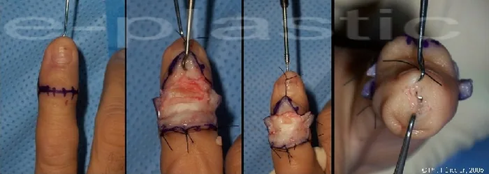 Arthroplastie — figure 6