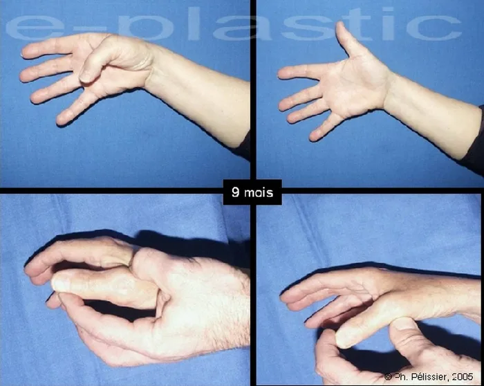 Arthroplastie — figure 7