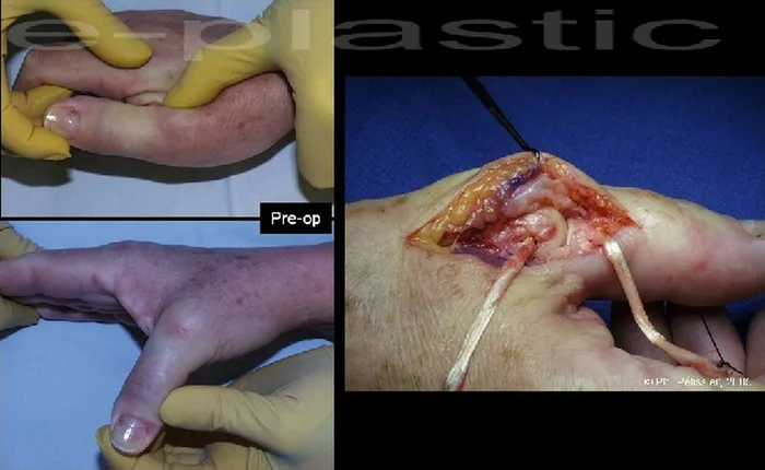 Arthroplastie — figure 8