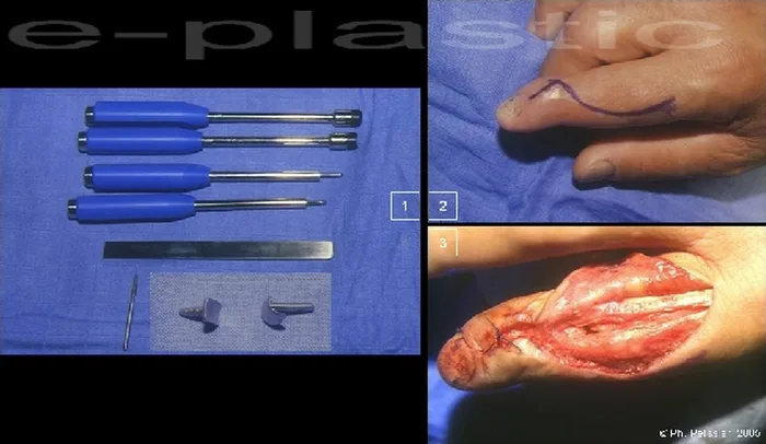 Arthroplastie — figure 9