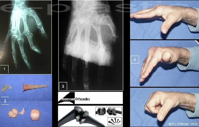 Arthroplastie — figure 11