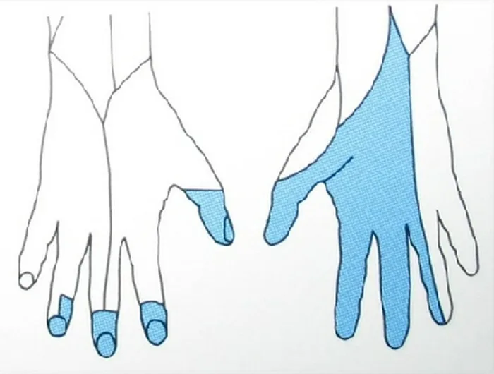 Canal carpien — figure 3