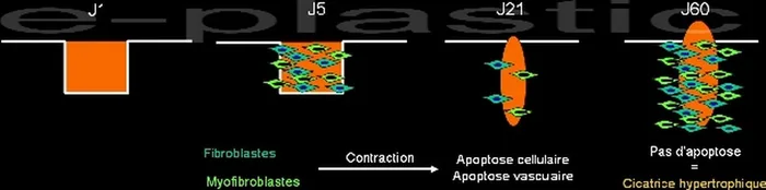 Cicatrisation pathologique — figure 1