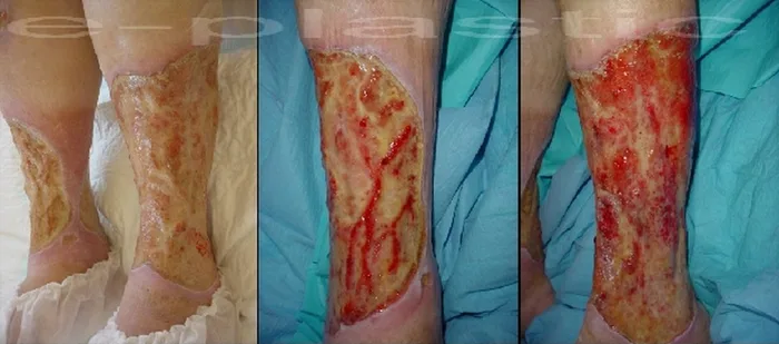Cicatrisation pathologique — figure 8