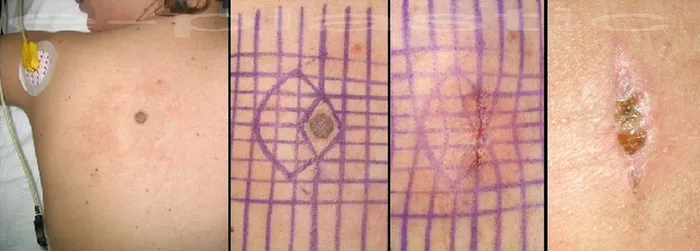 Cicatrisation pathologique — figure 11