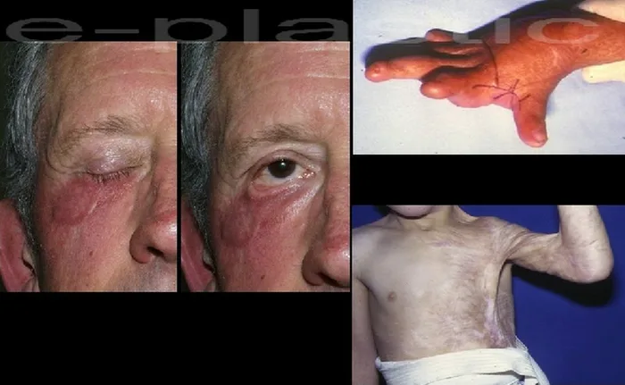 Cicatrisation pathologique — figure 18