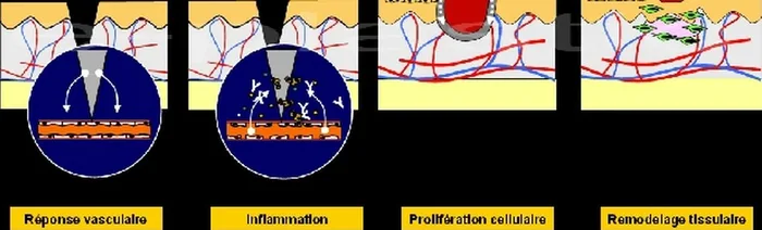Cicatrisation pathologique — figure 22