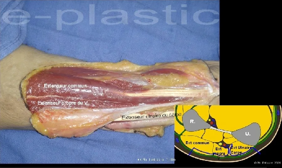 Incision de la berge radiale, extenseur commun des doigts