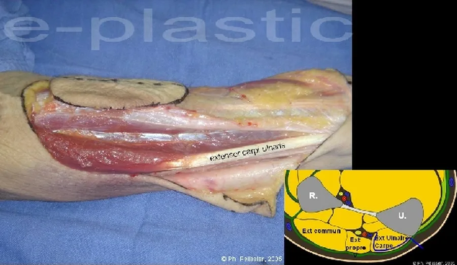 Incision de la berge ulnaire, extensor carpi ulnaris