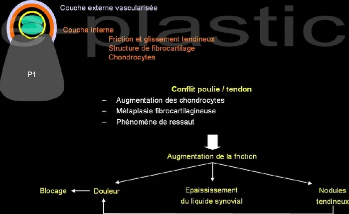 Doigt à ressaut — figure 5