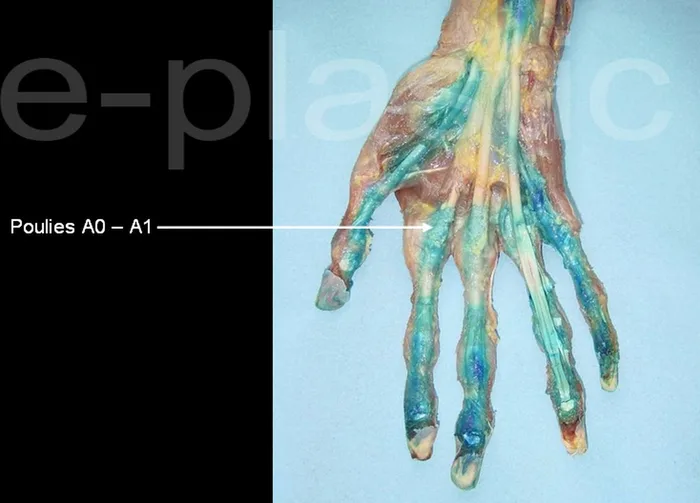 Doigt à ressaut — figure 6