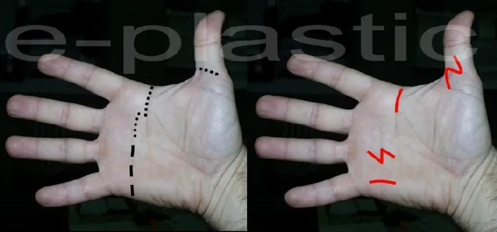 Doigt à ressaut — figure 7