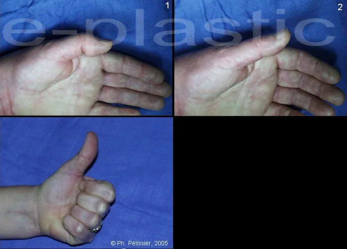 Doigt à ressaut — figure 18