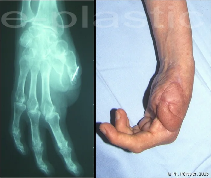 Radiographie et aspect pré-opératoires de l'amputation des deux premiers rayons