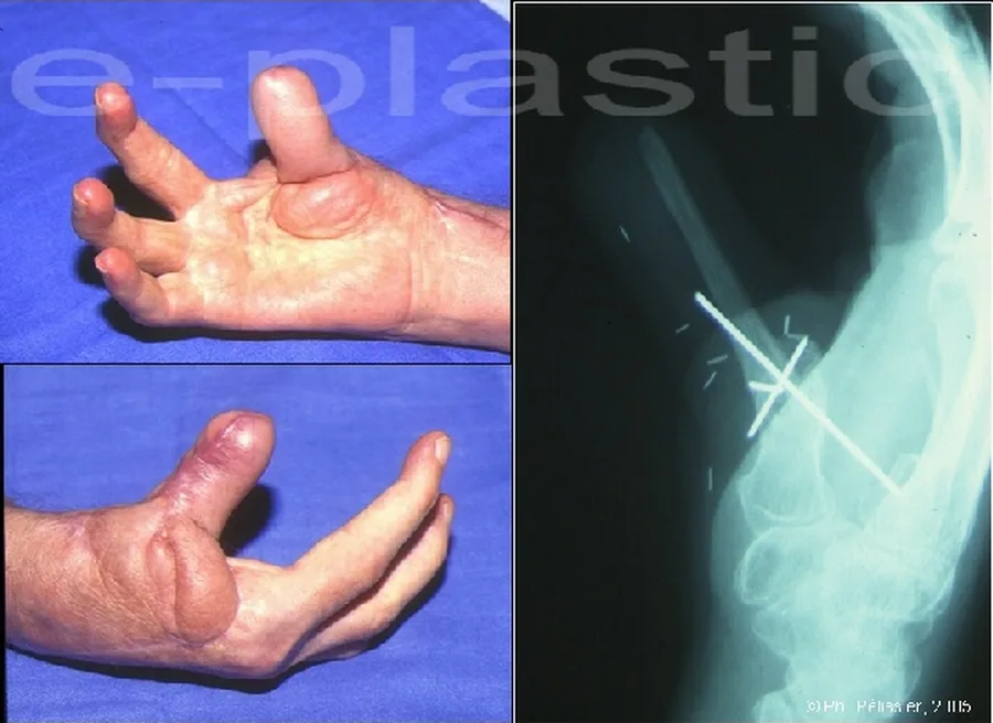 Résultat fonctionnel de la pince et radiographie de la fixation par broches