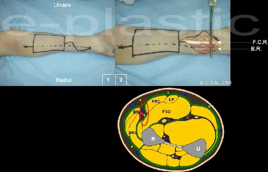 Tracé des repères et dissection du septum entre FCR et BR