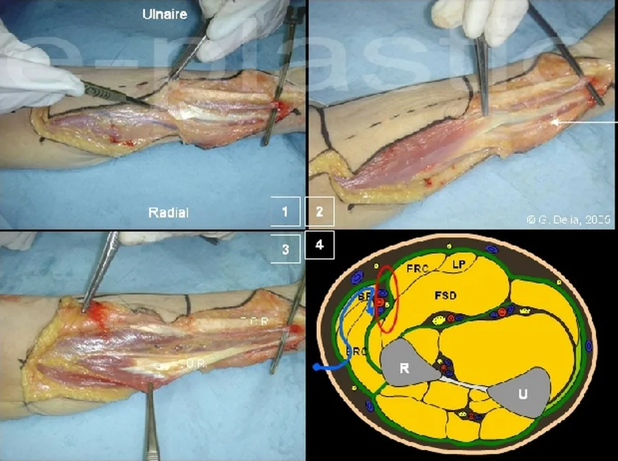 Incision de la berge radiale, muscle brachio-radial et branches sensitives du nerf radial