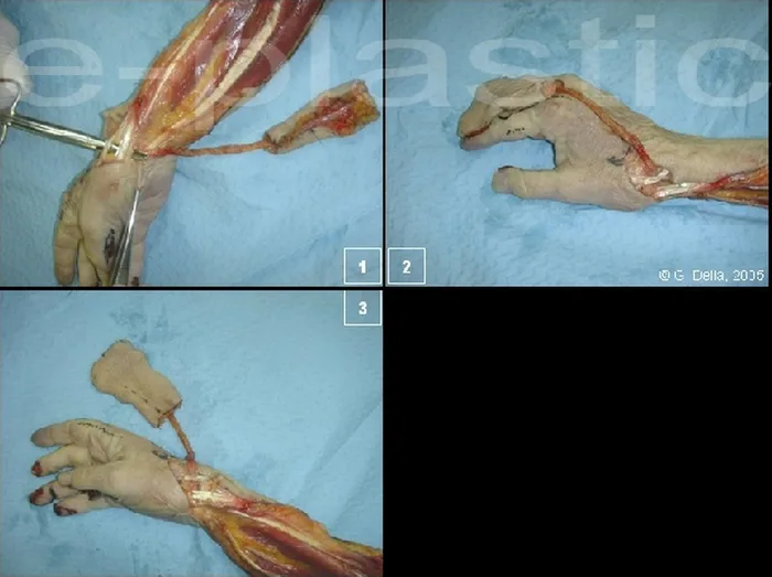 Décroisement du pédicule sous les tendons de la tabatière anatomique (Foucher)