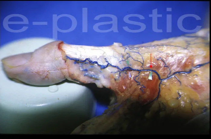 Dissection anatomique injectée montrant l'artère dorso-ulnaire du pouce