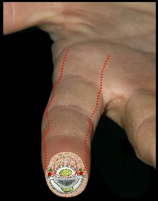 Fingertip avec tracé du lambeau d'Atasoy et coupe de la vascularisation pulpaire