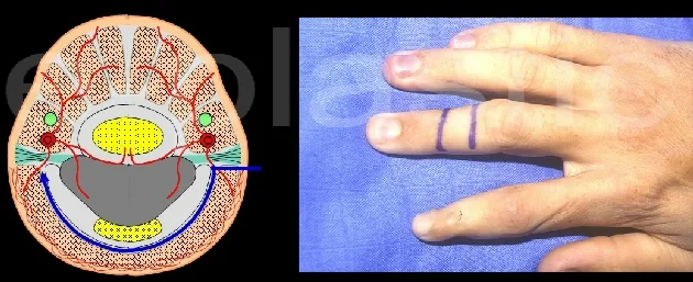 Coupe schématique de la vascularisation dorsale digitale et tracé du lambeau cross-finger