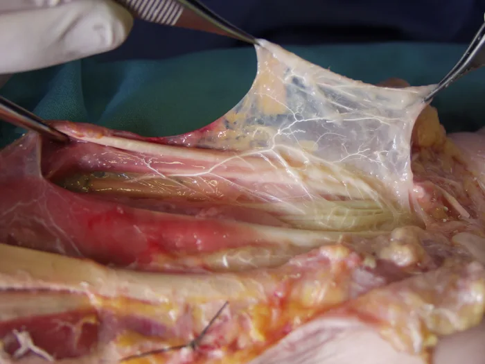 Dissection anatomique de la synoviale des fléchisseurs sur pièce cadavérique
