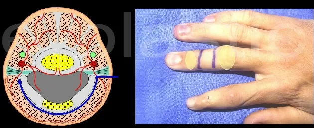 Dessin rectangulaire du lambeau cross-finger sur la face dorsale de la phalange