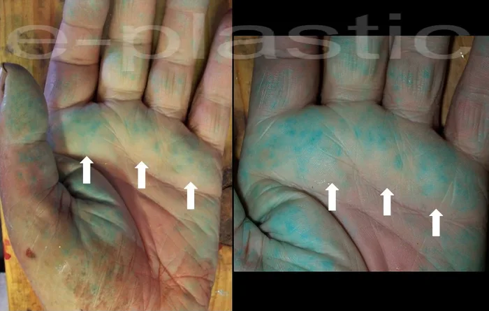 Injection colorée sur pièce anatomique montrant les spots vasculaires au sommet des commissures