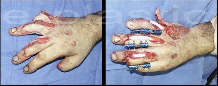 Pertes de substance dorsale des 3e, 4e et 5e doigts avec fractures de P1