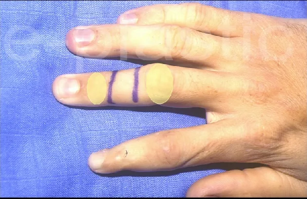 Section du ligament de Cleland pour l'avancement du lambeau cross-finger