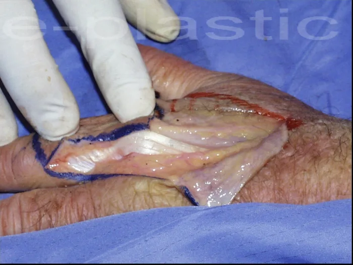 Incision radiale et aponévrose du premier interosseux dorsal, lambeau cerf-volant