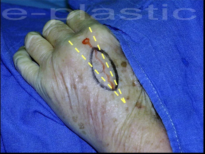 Incision des berges et réclinaison du tendon extenseur