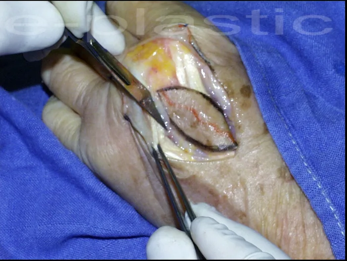 Incision aponévrotique de l'interosseux dorsal, lambeau intermétacarpien