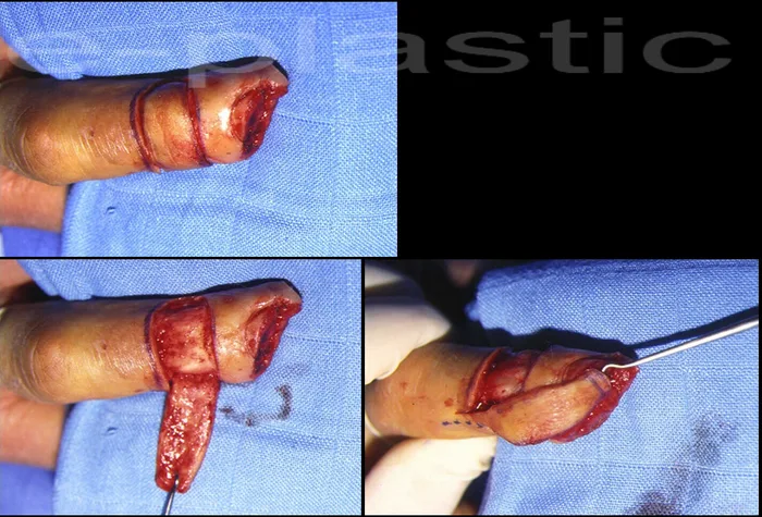 Amputation oblique radiale, préférence pour un lambeau dorsal en raison du Raynaud, cas clinique 1