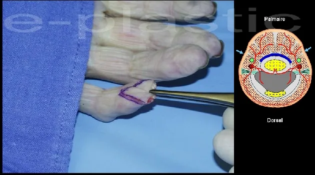 Avancement et fixation par broche du lambeau d'Atasoy