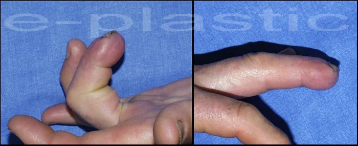 Couverture de l'extrémité osseuse exposée et greffe du site donneur, cas clinique 1