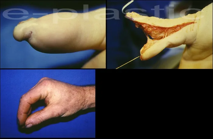 Traitement d'une dystrophie pulpaire par lambeau de Möberg, résultat à 2 ans, cas clinique 2