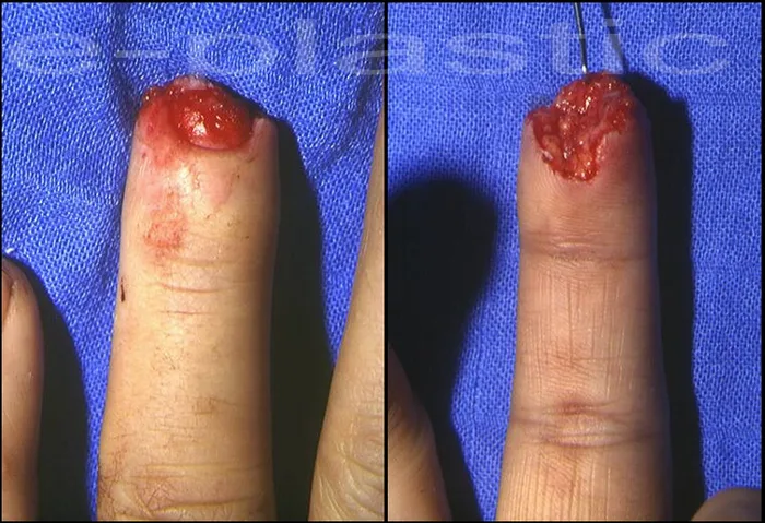 Amputation du 4e doigt par fendeuse à bûche, cas clinique 2