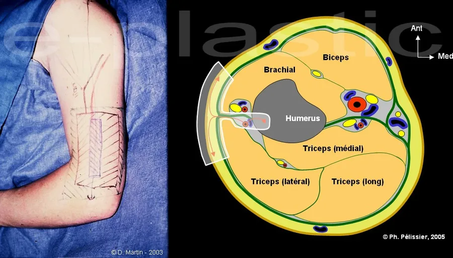 Tracé du lambeau ostéo-cutané brachial externe pour reconstruction de jambe