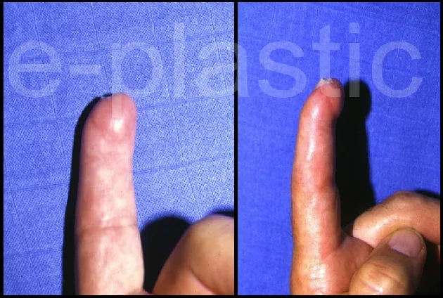 Amputation transversale du 2e doigt en zone II, cas clinique 2