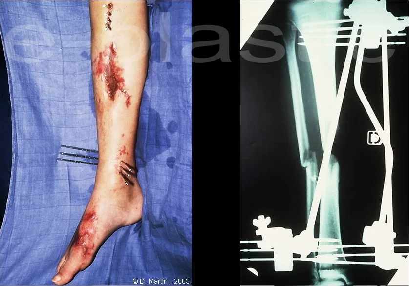 Fracture ouverte du tiers moyen de la jambe avant parage