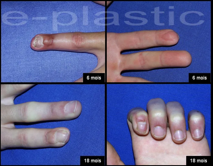 Évolution de l'ongle à 6 mois, cas clinique 3