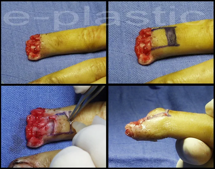 Évolution de l'ongle à 18 mois, cas clinique 3