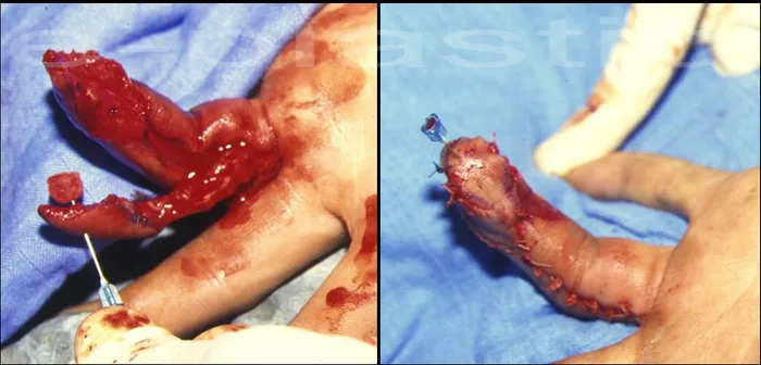 Avulsion de l'extrémité du 4e doigt dans un engrenage, cas clinique 3