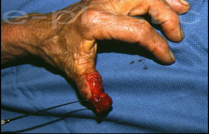 Avulsion distale de P2 du pouce par écrasement, cas clinique 2