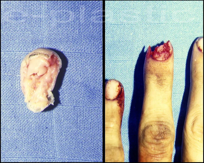 Reposition-lambeau selon Mantero-Foucher, cas clinique 3