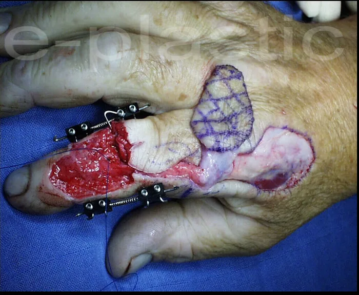 Réinsertion tendineuse par ancre Mitek et fixateur externe, cas clinique 2